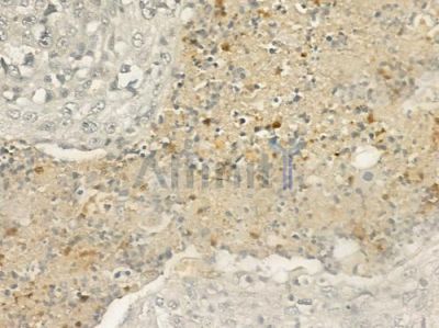Phospho-CDK6 (Tyr13) Antibody - AF2439 at 1/100 staining human esophageal carcinoma by IHC-P.