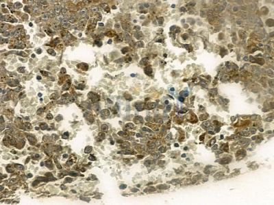 Phospho-CDK6 (Tyr13) Antibody - AF2439 at 1/100 staining human melanoma by IHC-P.