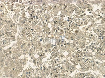 Phospho-CDK6 (Tyr292) Antibody - AF2441 at 1/100 staining human kidney cancer and para-carcinoma tissue by IHC-P.