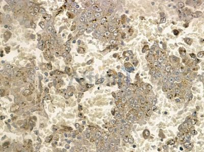 Phospho-PLCG2 (Tyr1217) Antibody - AF2442 at 1/100 staining human melanoma by IHC-P.