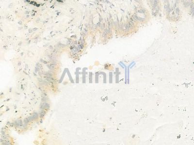 VWF Antibody - AF3000 at 1/100 staining human lung adenocarcinoma by IHC-P.