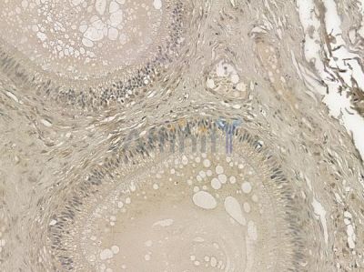 Phospho-Chk1 (Ser345) Antibody - AF3008 at 1/100 staining human testicular cancer by IHC-P.