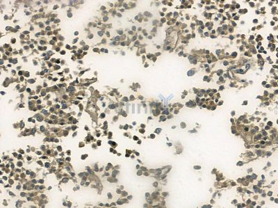 Phospho-p27 Kip1 (Thr187) Antibody - AF3324 at 1/100 staining human lung cancer by IHC-P.