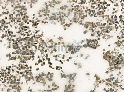 Phospho-p27 Kip1 (Thr187) Antibody - AF3324 at 1/100 staining human glioblastoma by IHC-P.