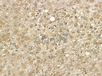 Cleaved-IL-1 beta (Asp116) Antibody - AF4006 at 1/100 staining human thyroid carcinoma by IHC-P.