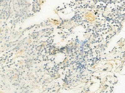 AQP0 Antibody - AF5194 at 1/100 staining human thyroid carcinoma by IHC-P.