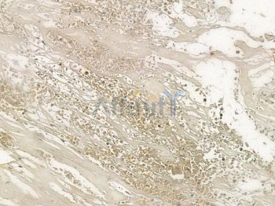 MGMT Antibody - AF5295 at 1/100 staining human breast carcinoma by IHC-P.