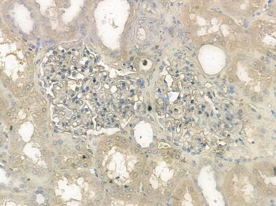 Cleaved-Notch2 (Asp1733) Antibody - AF5296 at 1/100 staining human pancreatic cancer by IHC-P.