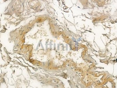 Integrin beta 5 Antibody - AF5327 at 1/100 staining human testicular cancer by IHC-P.