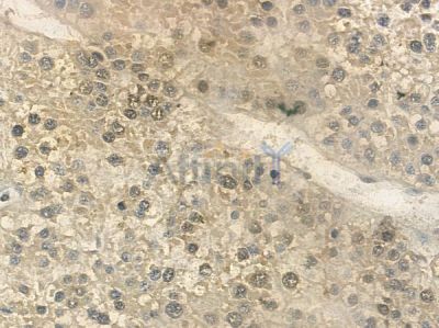 FRA2 Antibody - AF5345 at 1/100 staining human hepatocellular carcinoma by IHC-P.