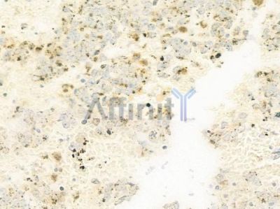 MARCKS Antibody - AF5398 at 1/100 staining human melanoma by IHC-P.