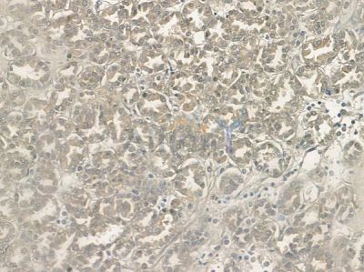 TXNRD2 Antibody - AF5399 at 1/100 staining human renal cell carcinoma by IHC-P.