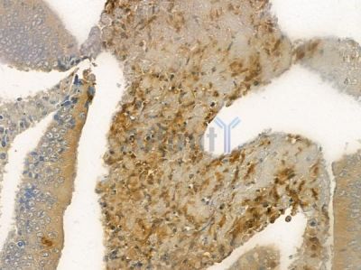 Dematin Antibody - AF5404 at 1/100 staining human colon carcinoma by IHC-P.