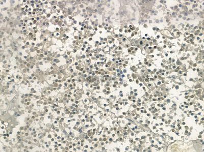 hnRPD Antibody - AF5419 at 1/100 staining human liver cancer and adjacent non-tumor tissue by IHC-P.
