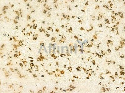 Daxx Antibody - AF5421 at 1/100 staining human melanoma by IHC-P.