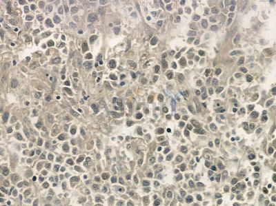 Phospho-Cyclin H (Thr315) Antibody - AF5426 at 1/100 staining human non-Hodgkin lymphoma by IHC-P.