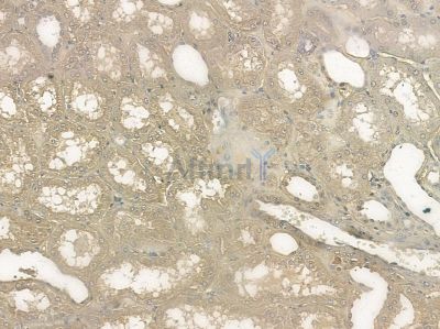 Phospho-Annexin A2 (Ser26) Antibody - AF5440 at 1/100 staining human pancreatic cancer by IHC-P.