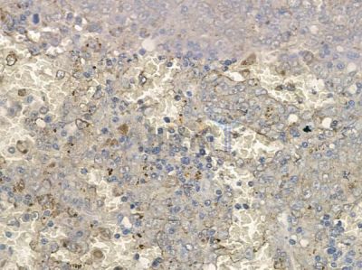 Phospho-Daxx (Ser668) Antibody - AF5441 at 1/100 staining human melanoma by IHC-P.