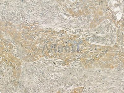 Phospho-MRLC1 (Ser19) Antibody  - AF5443 at 1/100 staining human tongue carcinoma by IHC-P.