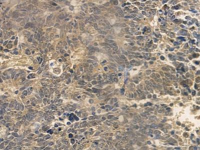 Cyclin E2 Antibody - AF5454 at 1/100 staining human small cell lung carcinoma by IHC-P.
