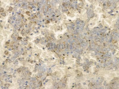 GluR2/3 Antibody - AF5458 at 1/100 staining human liver cancer by IHC-P.
