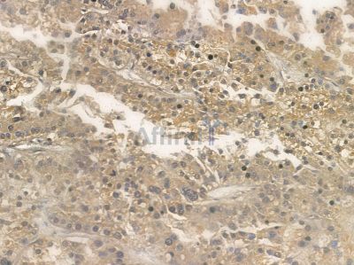GluR2/3 Antibody - AF5458 at 1/100 staining human ovarian cancer and adjacent non-tumor tissue by IHC-P.