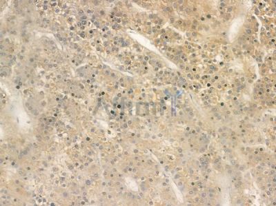 GluR2/3 Antibody - AF5458 at 1/100 staining human hepatocellular carcinoma by IHC-P.
