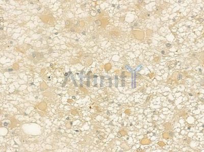mGluR4 Antibody - AF5459 at 1/100 staining human astrocytoma by IHC-P.