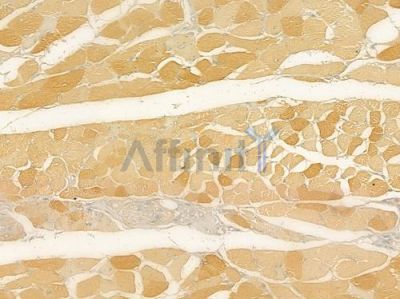 HSP20 Antibody - AF6003 at 1/100 staining human tongue carcinoma by IHC-P.