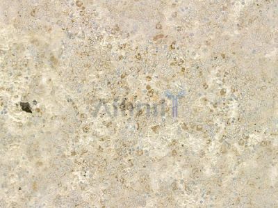IKK alpha/ beta Antibody - AF6013 at 1/100 staining human prostate carcinoma by IHC-P.
