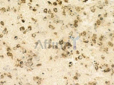 IKK alpha/ beta Antibody - AF6014 at 1/100 staining human melanoma by IHC-P.
