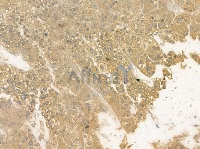 PDPK1 Antibody - AF6018 at 1/100 staining human hepatocellular carcinoma by IHC-P.