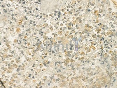 HER2/ErbB2 Antibody - AF6069 at 1/100 staining human prostate carcinoma by IHC-P.