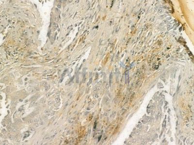 HER2/ErbB2 Antibody - AF6069 at 1/100 staining human lung squamous cell carcinoma by IHC-P.