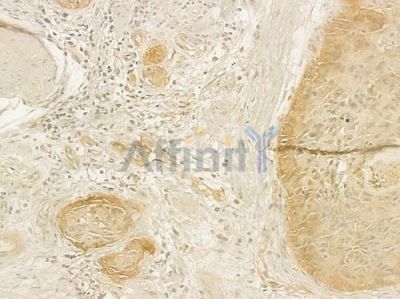 Integrin beta3 Antibody - AF6085 at 1/100 staining human esophageal carcinoma by IHC-P.