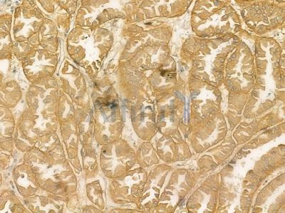 Integrin beta3 Antibody - AF6085 at 1/100 staining human renal cell carcinoma by IHC-P.