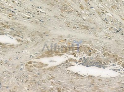 Vitamin D Receptor Antibody - AF6159 at 1/100 staining human lung squamous cell carcinoma by IHC-P.