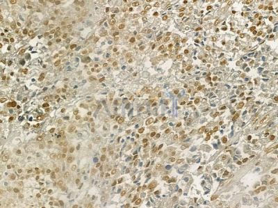 Vitamin D Receptor Antibody - AF6159 at 1/100 staining human prostate carcinoma by IHC-P.