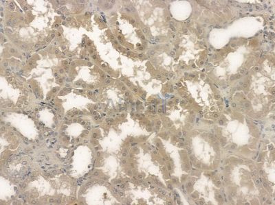 TNNI3 Antibody - AF6214 at 1/100 staining human pancreatic cancer by IHC-P.