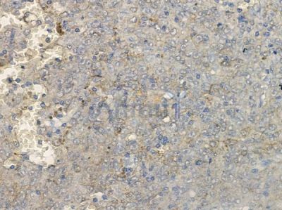 CBL Antibody - AF6225 at 1/100 staining human melanoma by IHC-P.