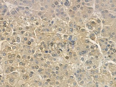 MKP1/2 Antibody - AF6243 at 1/100 staining human hepatocellular carcinoma by IHC-P.