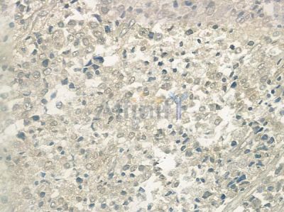 BRCA1 Antibody - AF6289 at 1/100 staining human prostate carcinoma by IHC-P.