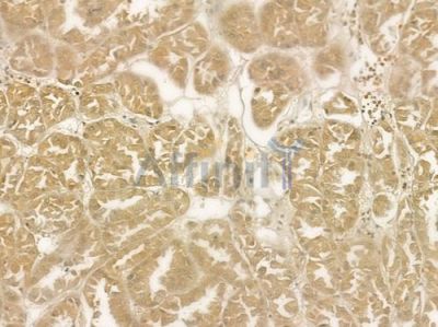STAT5A Antibody - AF6303 at 1/100 staining human renal cell carcinoma by IHC-P.
