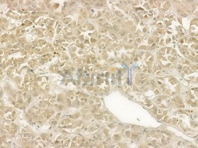 STAT5A Antibody - AF6303 at 1/100 staining human renal cell carcinoma by IHC-P.