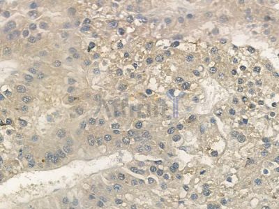 GluR1 Antibody - AF6306 at 1/100 staining human hepatocellular carcinoma by IHC-P.