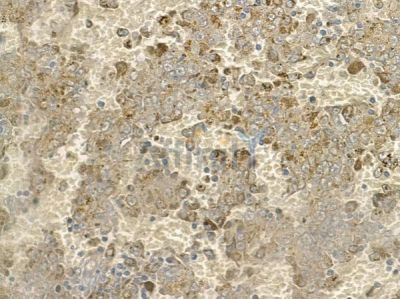 JNK1/2/3 Antibody - AF6319 at 1/100 staining human melanoma by IHC-P.