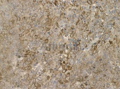 LIMK1/2 Antibody - AF6344 at 1/100 staining human melanoma by IHC-P.