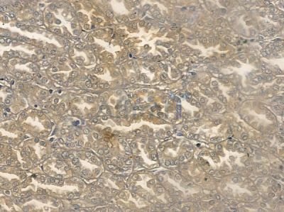 Ataxin 1 Antibody - AF6347 at 1/100 staining human renal cell carcinoma by IHC-P.