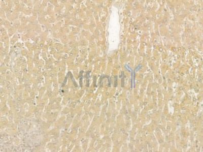 HSL Antibody - AF6403 at 1/100 staining human hepatocellular carcinoma by IHC-P.