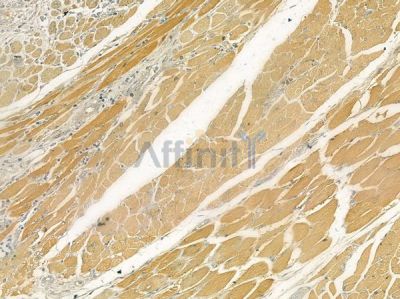 Caldesmon Antibody - AF6411 at 1/100 staining human tongue carcinoma by IHC-P.